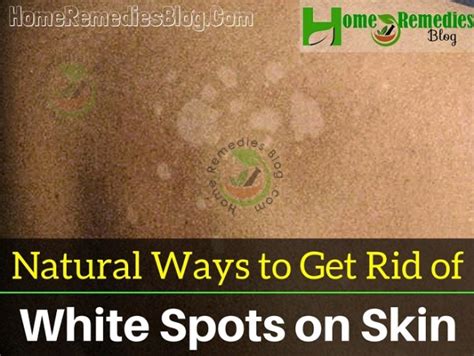 How To Get Rid Of White Spots On Skin Causes And Home Remedies Home