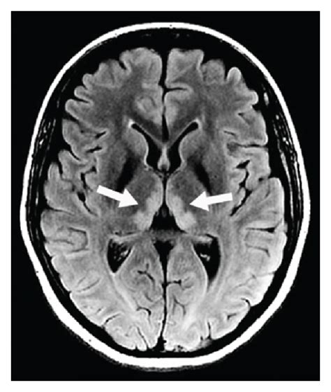 Thalamic Lesions A Radiological Review