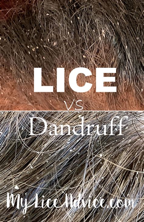 17 Lice Symptoms With Pictures Signs That You Have Head Lice My Lice Advice