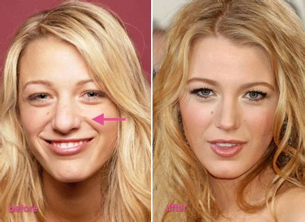 We did not find results for: Celebrity Nose Jobs: Black Lively Nose Job Plastic Surgery ...