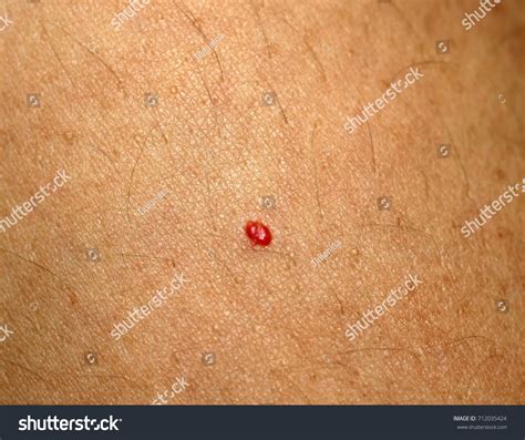 Angioma Red Mole On Body Birthmark Stock Photo 712035424 Shutterstock