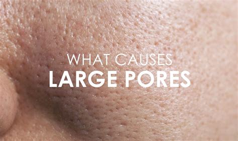 Enlarged Pores On The Face Causes Symptoms Premier Clinic