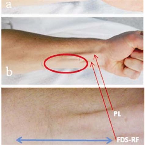 Pdf Treatment Of A Symptomatic Forearm Muscle Herniation With A Wrap