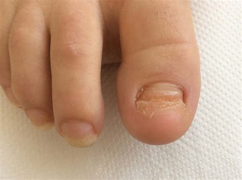 Discover More Than 135 Fake Toenails For Missing Nail Latest Vn