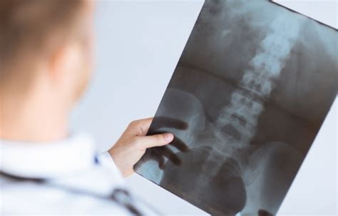 Why Chiropractors Use X Rays As A Diagnostic Tool For Treatment