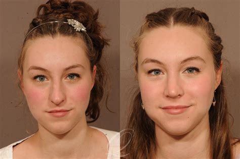 Rhinoplasty Before After Photos Patient 1515 Serving Rochester