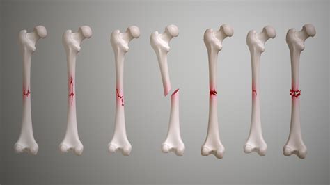 Types Of Bone Fractures List