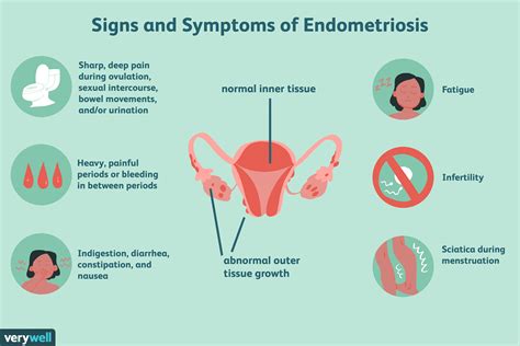 Causes Of Endometriosis Disease Fomwan
