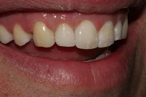 Before And After Dental Bonding And Tooth Colored Fillings Photos