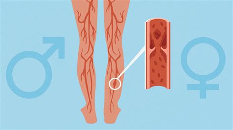 The Truth About Sex Differences In Deep Vein Thrombosis Everyday Health