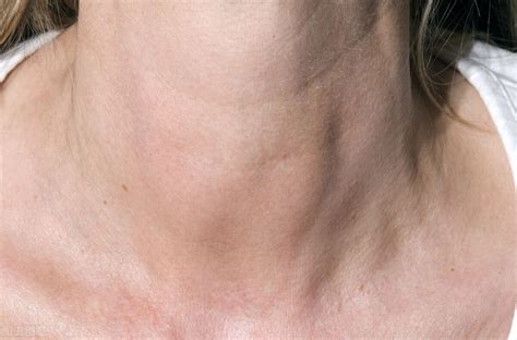 甲状腺全切、半切不仅会产生疤痕，这些副作用也要警惕！ 知乎