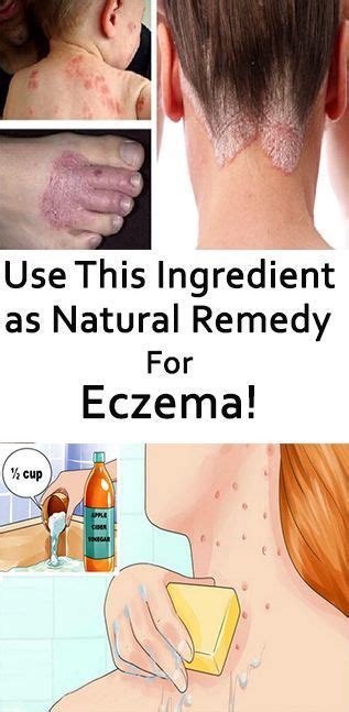 Fitness Remedies Natural Eczema Remedies Eczema Remedies Health