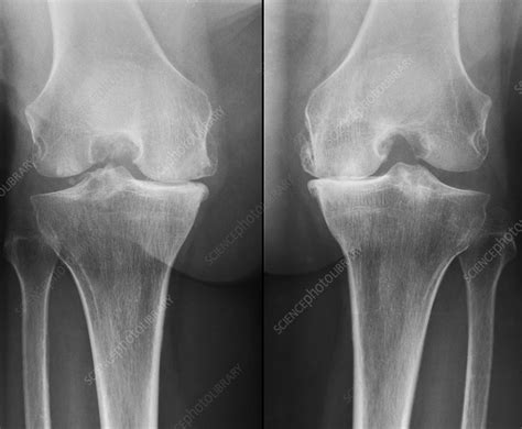 Knees In Osteoarthritis X Ray Stock Image C Science Photo Library