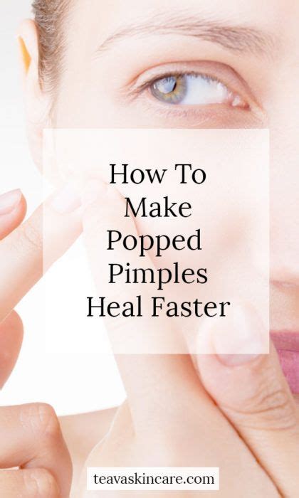 And you probably don't even recognize why this works sometimes. How to Make Popped Pimples Heal Faster - Teava Skincare ...