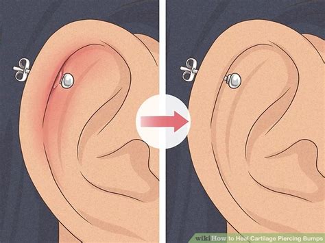 5 Ways To Heal Cartilage Piercing Bumps Wikihow Piercing Bump Cartilage Piercing Ear Piercings