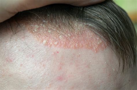 What Causes Bald Patches On The Scalp Stdgov Blog