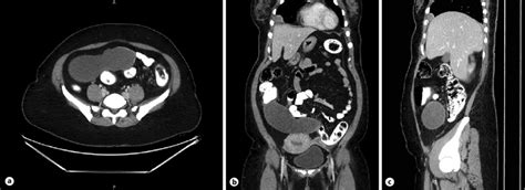 Intravenous Oral And Rectal Multiplanar Contrast Enhanced Ct Of The