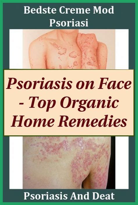 Guttate Psoriasis On Face Best Diet Plan For Psoriasis Psoriasis
