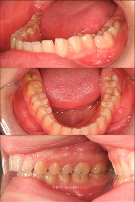 Figure 6 From Uprighting An Impacted Permanent Mandibular First Molar
