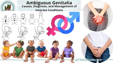 Ambiguous Genitalia Causes Diagnosis And Management Of Intersex