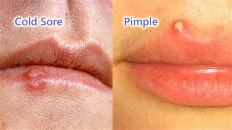 Pimple Or Cold Sore Difference Causes Prevention And Treatment
