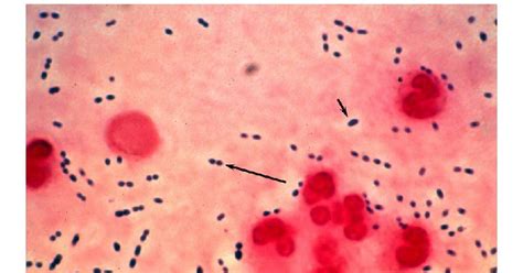 Welcome Bakteri Streptococcus Pneumoniae Pada Penyakit Pneumonia