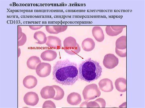 Хронический лимфолейкоз lympholeucosis chronica этиология патогенез Картинка - Хронический лимфолейкоз lympholeucosis chronica этиология патогенез
