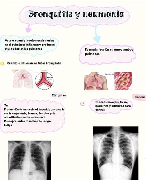 Bronquitis y neumonía Camila Jara salas uDocz