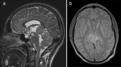 Brain Mri At Initial Diagnosis Of Germ Cell Tumor T2 Weighted Images