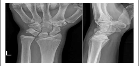 Pediatric Ulnar Sided Wrist Pain A Review Of The Current Li Jaaos