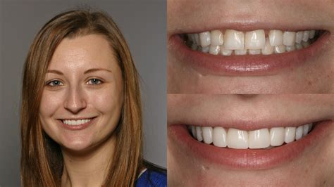Before After Composite Veneers Treatment