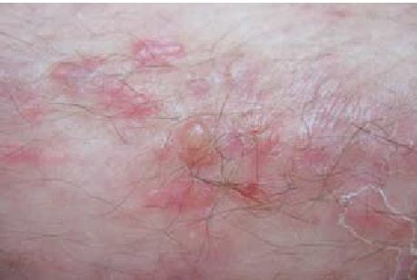 Lesions May Vary And Include Urticarial Papules And Plaques Erythema Download Scientific