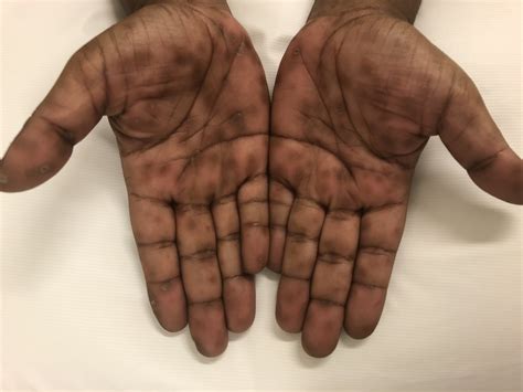 Dark Skin Rash On Hands Printable Templates Protal