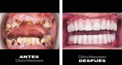Rehabilitación Oral Completa Caso 53 Clínica Manzanera