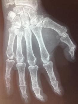 Угольник swanson, это должен знать каждый плотник. prothese ou arthrodese de doigt pathologies et operations ...