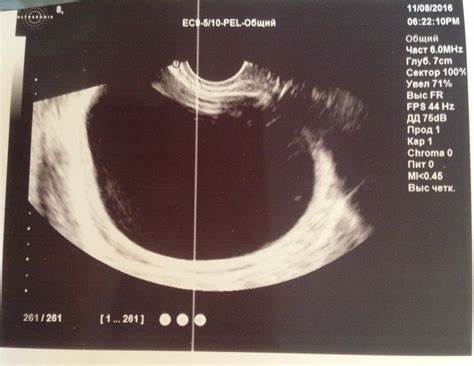 Диета киста яичника Киста яичника, отправляют на операцию - Вопрос гинекологу - 03 Онлайн Киста яичника, отправляют на операцию - Вопрос гинекологу - 03 Онлайн Диета киста яичника
