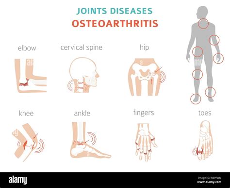 Arthritis Osteoarthritis Medical Infographic Design Joint Replacement