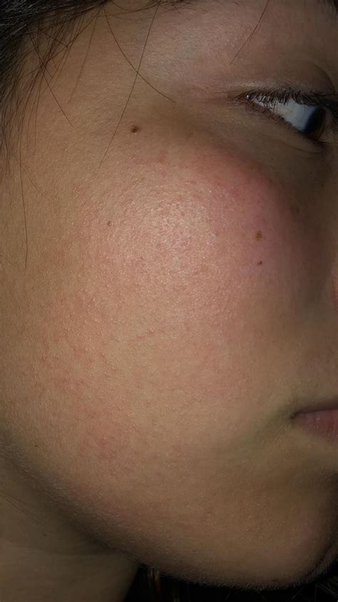 Does Anybody Know Why I Could Possibly Suddenly Have These Little Bumps