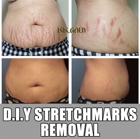 How To Get Rid Of Stretch Marks Permanently Stretch Mark Removal