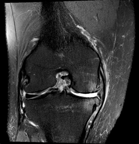 Coronal T2 Weighted Mri Image Of A Knee With A Chronic Acl Tear With A