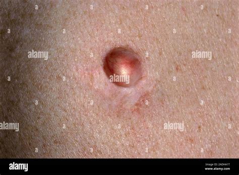 Recurrent Sebaceous Cyst Close Up Of A Small Flesh Coloured Lump On An