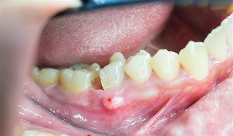 How To Drain Abscess Under Tooth Reverasite