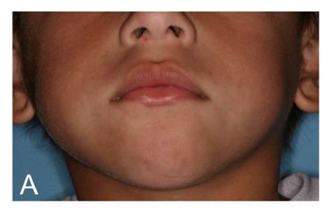 A Initial Clinical Appearance Showing A Swelling On The Right Side Of