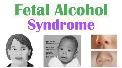 Fetal Alcohol Syndrome Fas Risk Factors Pathophysiology Signs Symptoms Diagnosis
