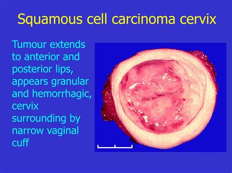 Ppt Tumors Of Cervix Powerpoint Presentation Free Download Id6141844