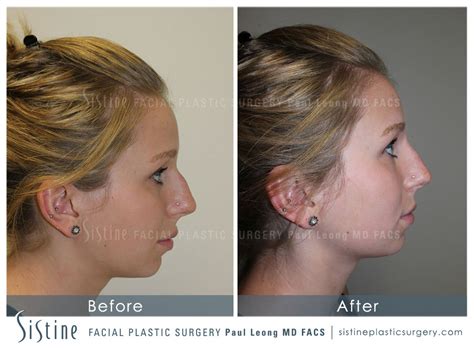 Restylane Juvederm Before And After 38 Sistine Facial Plastic Surgery