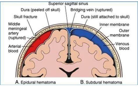 Head trauma from playing sports, taking a serious fall, or experiencing an automobile accident can potentially lead to the rupturing of a blood vessel in the brain and result in brain bleeding. Subdural vs epidural hematoma | Radiologie, Médecine, Cerveau