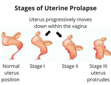 How Severe Is Your Prolapse What Your Prolapse Diagnosis Means