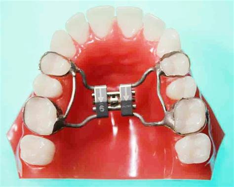 Palatal Expander It Helps Widen The Upper Jaw To Correct Cross Bites