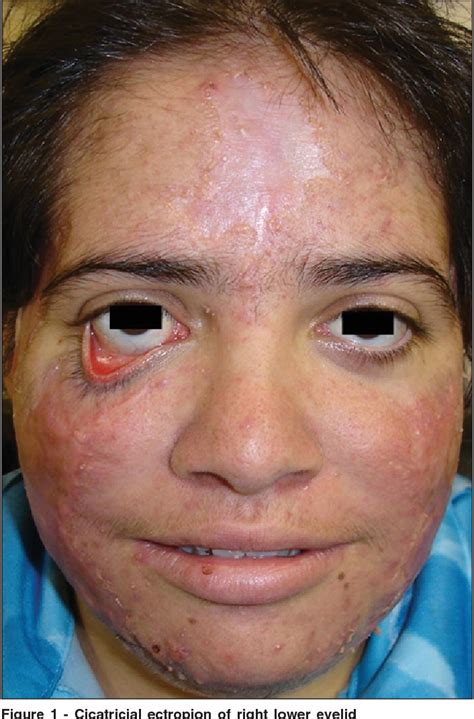 Figure 1 From Cicatricial Ectropion Correction In A Patient With